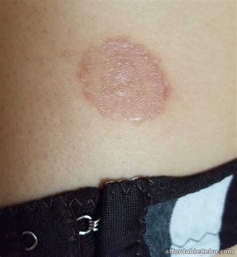 buni sa ari ng babae|Buni (Ringworm) .